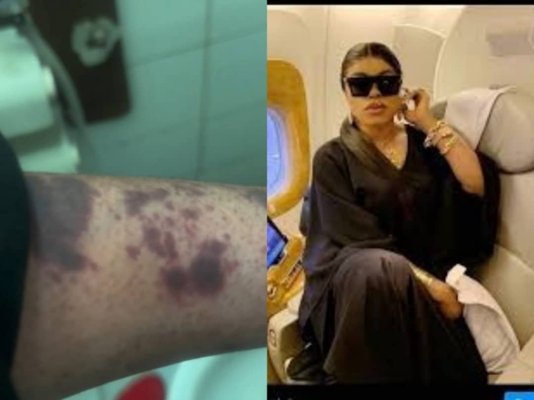 Bobrisky removed from Amsterdam bound flight claims injuries from immigration officers Bobrisky removed from Amsterdam bound flight claims injuries from immigration officers